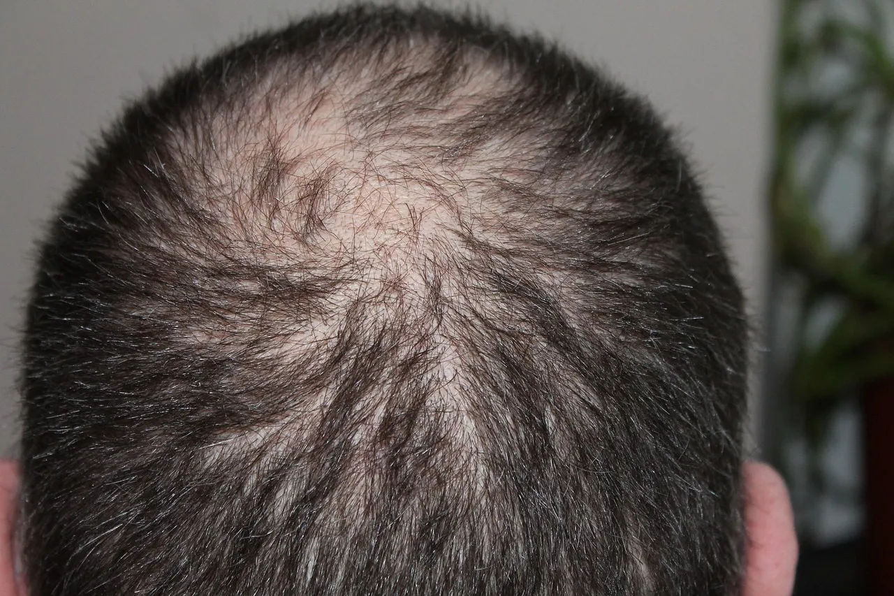 hair loss after weight loss